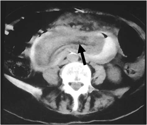 Ct Scan Axial Cut Showing The Sausage Appearance Of Intussusception As Download Scientific