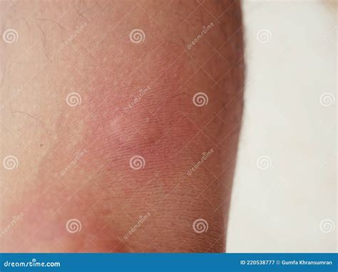 A Bruise That Has Been Stung By An Insect Stock Image Image Of Bite