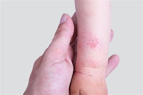 Dermatite atópica o que é sintomas causas e tratamento Tua Saúde