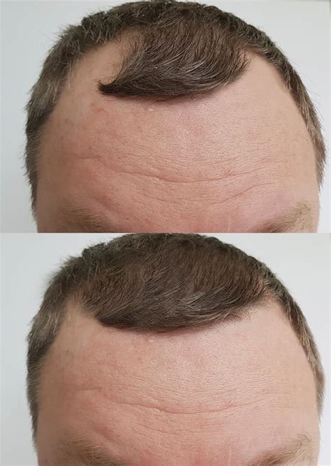 Male Pattern Baldness Everything You Need To Know Fashionbeans