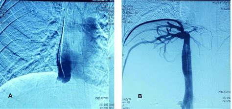 Trans Jugular A And Trans Femoral B Catheter Venography Of The Ivc