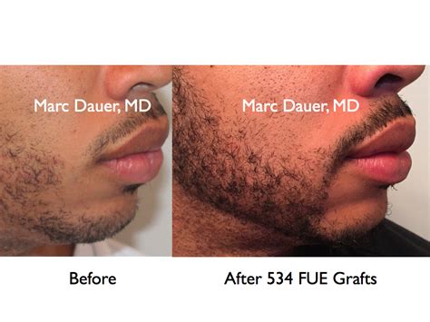 Beard Transplant Via Fue Marc Dauer Md Hair Transplant Doctor Los