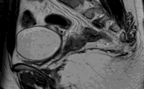 Ultrasound of right adnexal mass. | Download Scientific Diagram