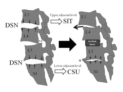 The Schema Of The Adjacent Disc Disease After Fusion Surgery The Download Scientific Diagram