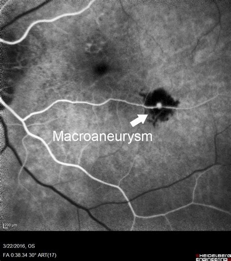 Retinal Macroaneurysm Scott E Pautler Md Tampa