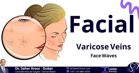 Face Waves - Facial Varicose Veins - 7 Varicose Veins Clinics Dubai