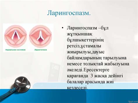 Ларингоспазм. Бронхоспазм - презентация онлайн