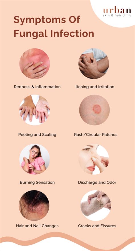 Fungal Infection Types Causes Symptoms Treatment Urban Skin And