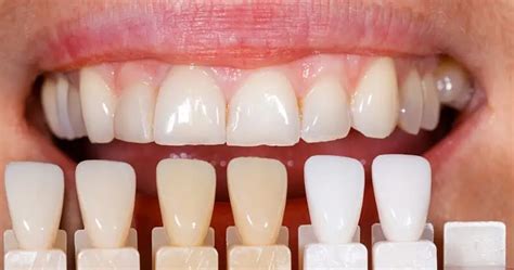 A Detailed Guide To Porcelain Veneer Costs Insurance Cover Dentaly Org