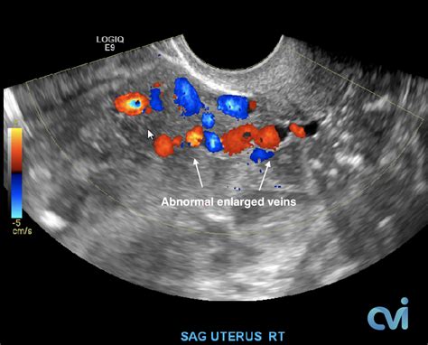 Pelvic Congestion Syndrome - Pelvic Pain Embolization Treatment