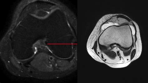 Acl Tear Grading Mri