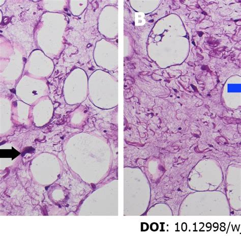 Pathologic Picture Of Well Differentiated Liposarcoma A Atypical