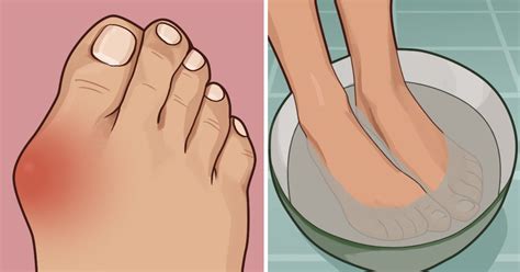 Great Natural Ways To Treat Bunions That Don T Require Surgery