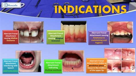 Frenectomy Ppt