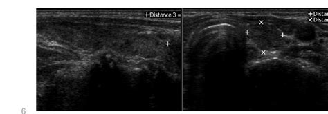 TUS of atrophic thyroiditis (a patient with mild hypothyroidism: TSH ...