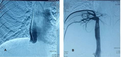 Trans Jugular A And Trans Femoral B Catheter Venography Of The Ivc