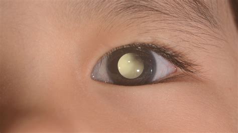 Retinoblastoma Symptoms Causes Treatment Outlook