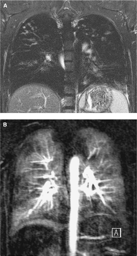 Figure 2 From Imaging Of Pulmonary Pathologies Semantic Scholar