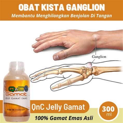 Jual Obat Benjolan Di Tangan Kista Ganglion Lipoma Qnc Jelly Gamat