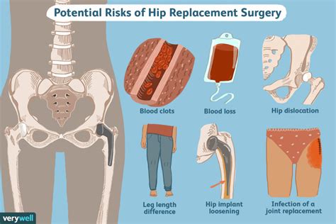 Exploring Alternatives To Knee Replacement Surgery Ask The Nurse Expert