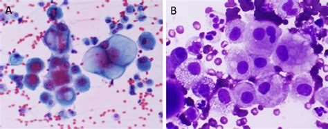 Mesothelial Cells In Pleural Fluid