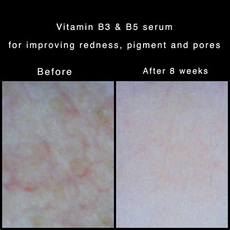 Vitamin B3 Vs B5 So Sánh Và Lợi ích Của Niacinamide Và Panthenol