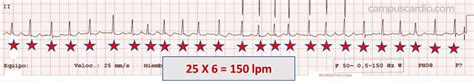 Calcule La Frecuencia Cardíaca En Este Electrocardiograma