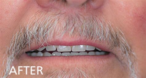 Smile Gallery Verroche Denture Clinic St Catharines Ontario