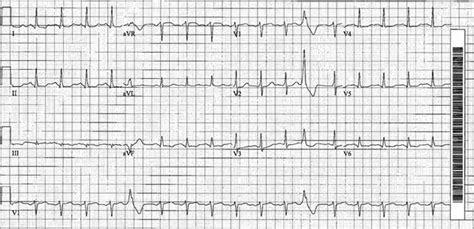 Presenting electrocardiogram. | Download Scientific Diagram