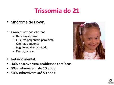 Trissomia Do S Ndr