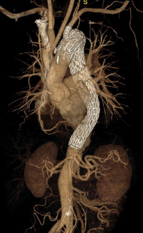 Thoracic Aneurysm And Dissection Uwmtap