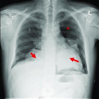 Chest Radiograph Posterior Anterior Projection Showing Left And Right