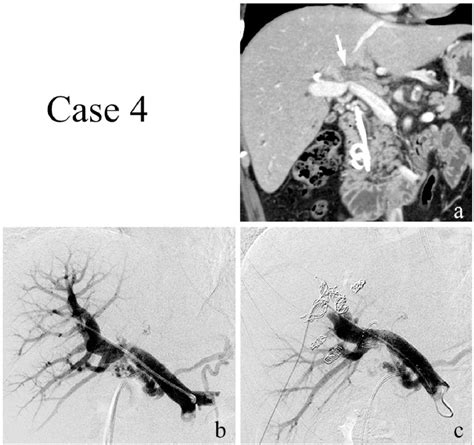 Figure From Percutaneous Transhepatic Portal Vein Embolization With