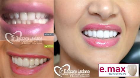 Facettes Dentaires Veneers E Max Dr Bassem Jaidane Vacance Tunisie