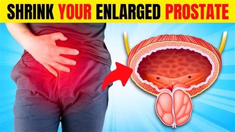 Best Foods To Shrink Enlarged Prostate Reduce Symptoms And Risk