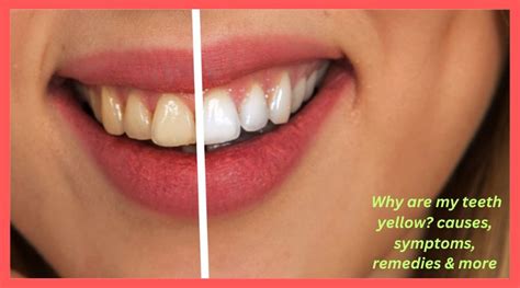 Why Are My Teeth Yellow Causes Symptoms Remedies And More