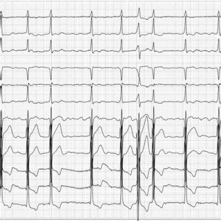 ECG Image The Electrocardiogram Showed Atrial Fibrillation