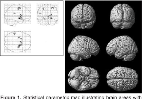 Figure 1 From Changes In Cerebral Cortex And Limbic Brain Functions