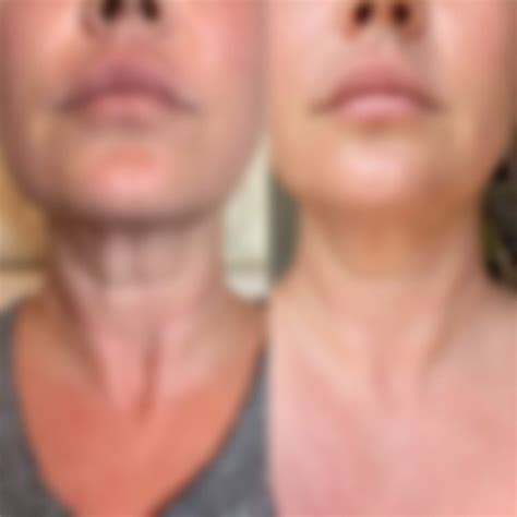 Opus Fractional Plasma — Evolve Skin Spa And Wellness Carlsbad