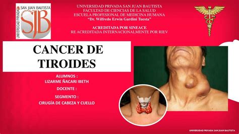 Cáncer de Tiroides Ibeth Lizarme Ñacari uDocz