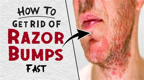 How To Get Rid Of Razor Bumps Fast Home Remedies For Razor Bumps Razor Burn Treatment Youtube