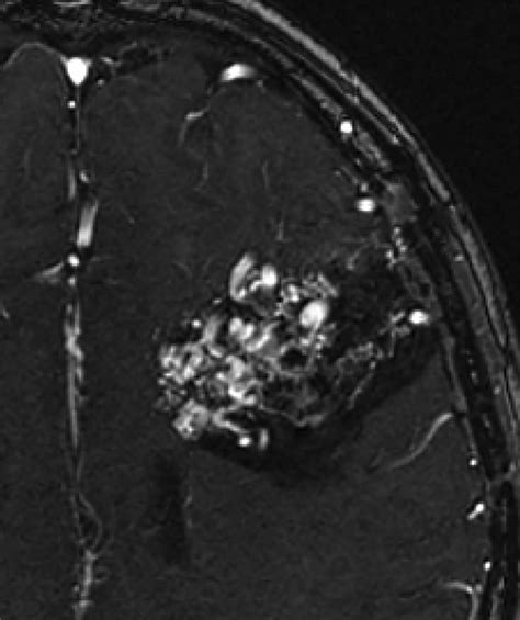 Contemporary Imaging Of Cerebral Arteriovenous Malformations Ajr