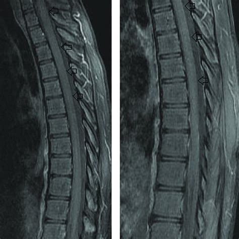 A B Sagittal Postcontrast Fat Saturated T1 Weighted Images Showing