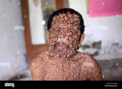 Neurofibromatose Typ