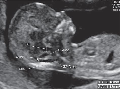 Spina Bifida Ultrasound 13 Weeks