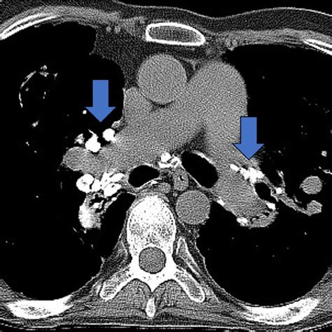 Calcification Of Lymph Nodes Download Scientific Diagram