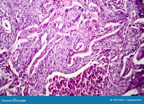 Lung Adenocarcinoma Light Micrograph Stock Image Image Of Eosin