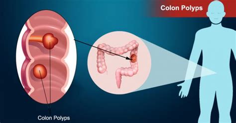 Colorectal Polyps Causes Symptoms And DiagnosisDr D R Kulkarni GI