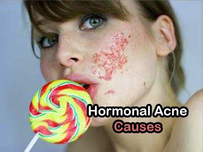 What Causes Hormonal Acne and How to Cope with? | Hormonal Acne Tips