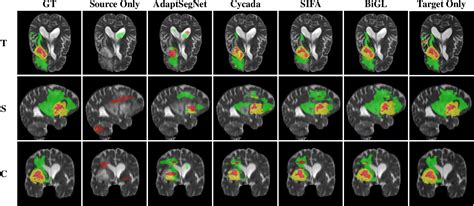 Figure From Cross Modality Brain Tumor Segmentation Via Bidirectional